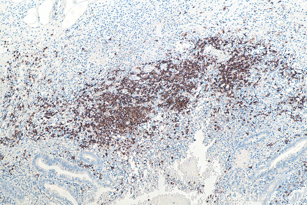 Immunohistochemical analysis of paraffin-embedded human appendicitis tissue slide using KHC0018 (CD20 IHC Kit).