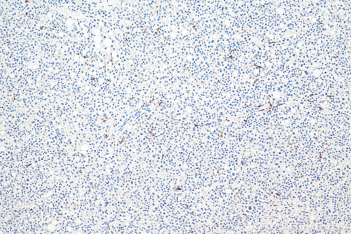 Immunohistochemical analysis of paraffin-embedded human liver cancer tissue slide using KHC0007 (CD206 IHC Kit).