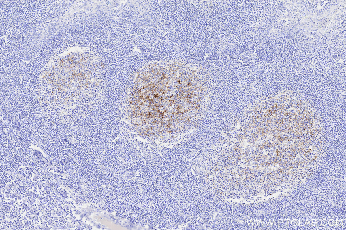 Immunohistochemical analysis of paraffin-embedded human tonsillitis tissue slide using KHC3310 (CD21 IHC Kit).