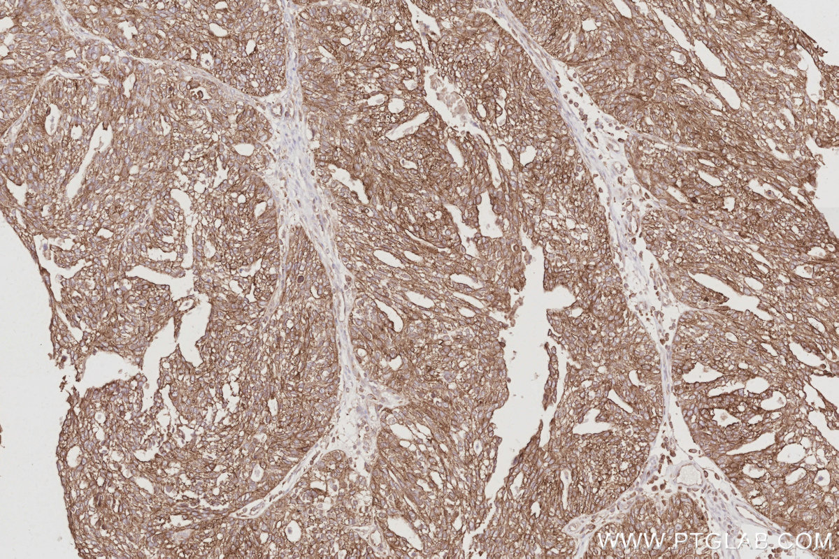 Immunohistochemical analysis of paraffin-embedded human ovary cancer tissue slide using KHC3079 (CD2AP IHC Kit). Immunohistochemical analysis of paraffin-embedded human ovary cancer tissue slide using KHC3079 (CD2AP IHC Kit).