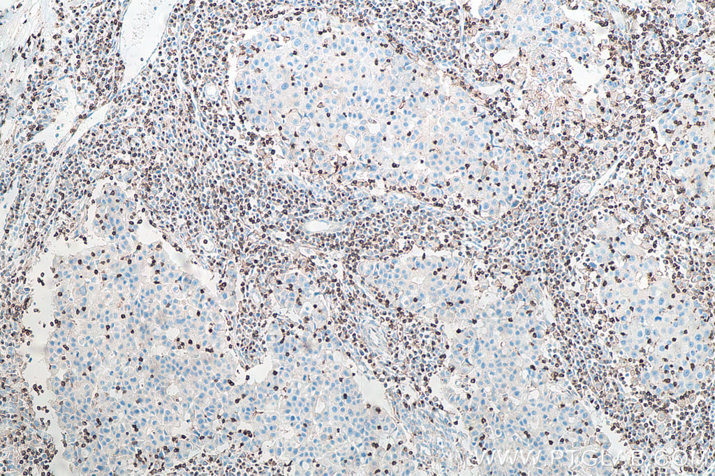 Immunohistochemical analysis of paraffin-embedded human breast cancer tissue slide using KHC0013 (CD3 IHC Kit).