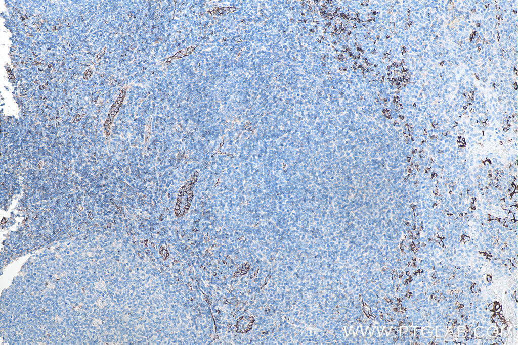 Immunohistochemical analysis of paraffin-embedded human tonsillitis tissue slide using KHC0022 (CD31 IHC Kit).