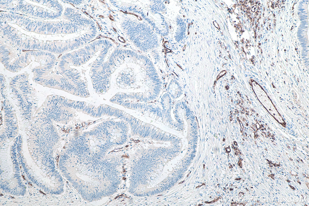 Immunohistochemical analysis of paraffin-embedded human colon cancer tissue slide using KHC0022 (CD31 IHC Kit).