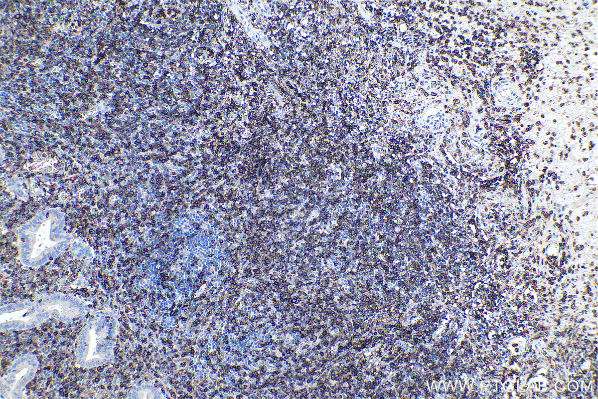 Immunohistochemical analysis of paraffin-embedded human appendicitis tissue slide using KHC0015 (CD43 IHC Kit).
