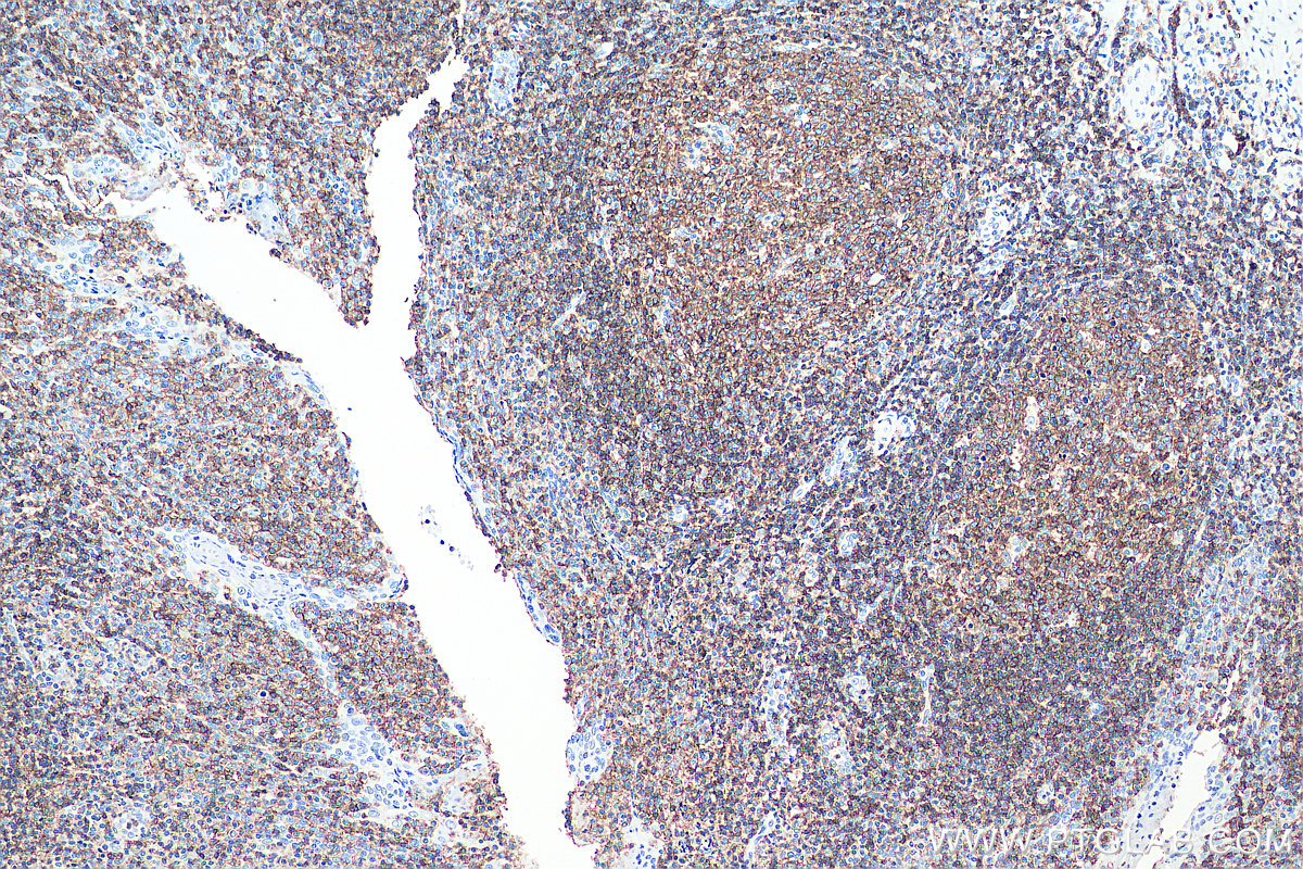 Immunohistochemical analysis of paraffin-embedded human tonsillitis tissue slide using KHC0031 (CD45 IHC Kit).