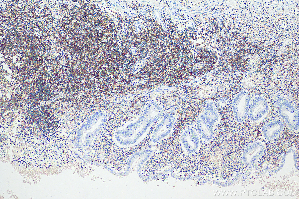 Immunohistochemical analysis of paraffin-embedded human appendicitis tissue slide using KHC0031 (CD45 IHC Kit).