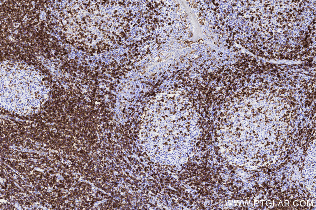 Immunohistochemical analysis of paraffin-embedded human tonsillitis tissue slide using KHC3311 (CD5 IHC Kit).