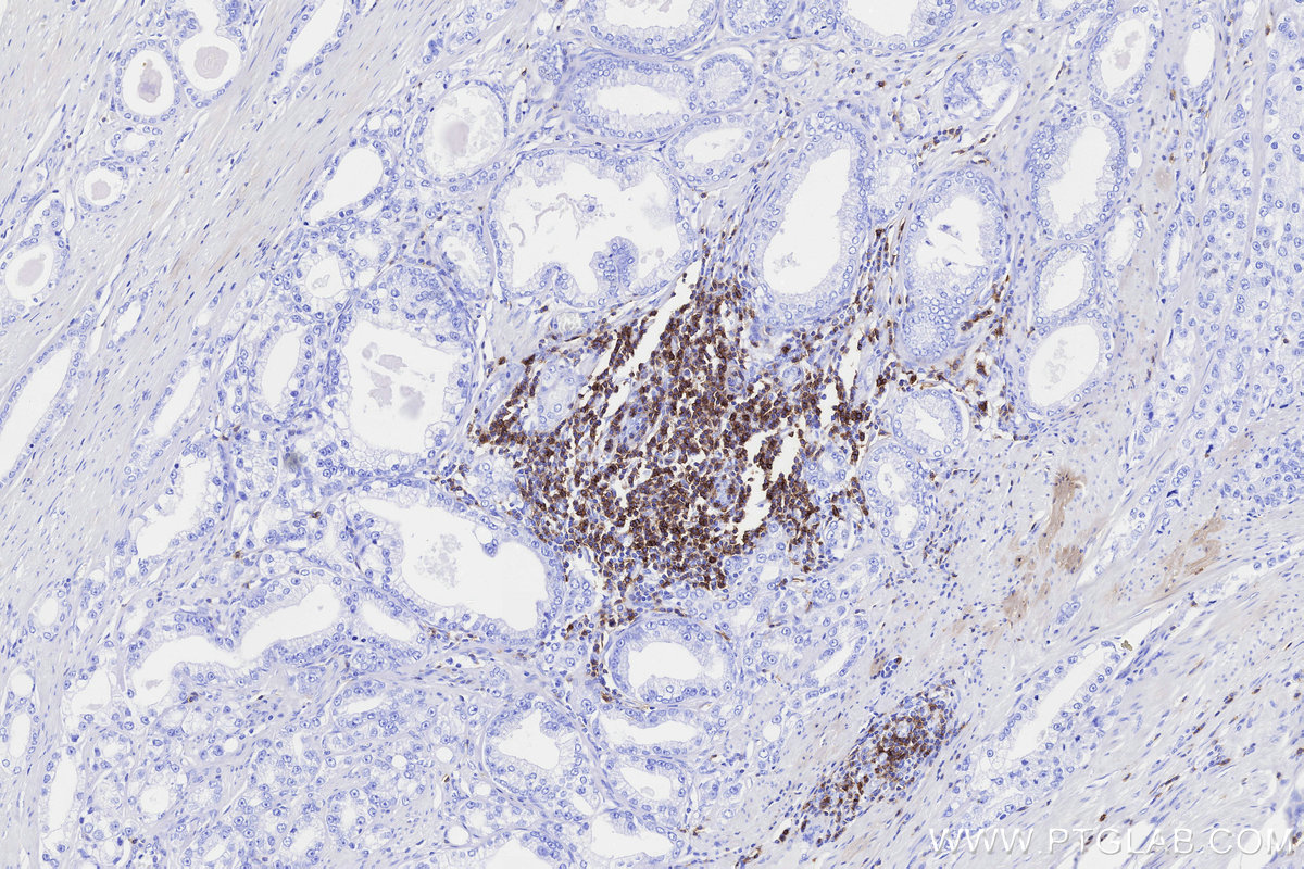 Immunohistochemical analysis of paraffin-embedded human prostate cancer tissue slide using KHC3311 (CD5 IHC Kit).