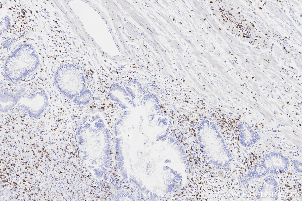 Immunohistochemical analysis of paraffin-embedded human rectal cancer tissue slide using KHC3311 (CD5 IHC Kit).