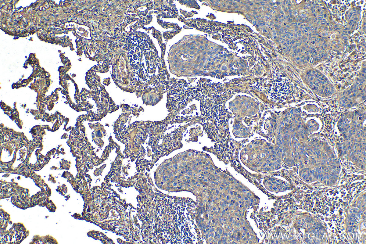 Immunohistochemical analysis of paraffin-embedded human lung cancer tissue slide using KHC1230 (CD59 IHC Kit).