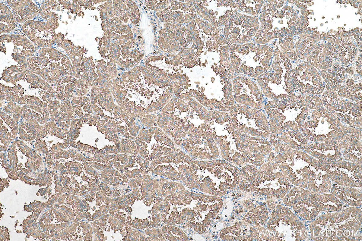 Immunohistochemical analysis of paraffin-embedded human lung cancer tissue slide using KHC0722 (CD63 IHC Kit).