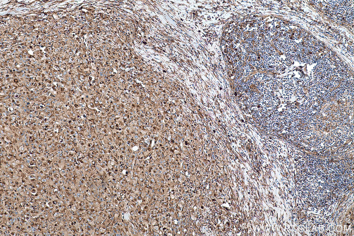 Immunohistochemical analysis of paraffin-embedded human lymphoma tissue slide using KHC0722 (CD63 IHC Kit).