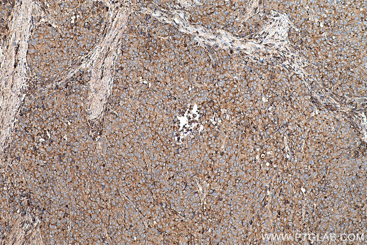 Immunohistochemical analysis of paraffin-embedded human stomach cancer tissue slide using KHC0722 (CD63 IHC Kit).