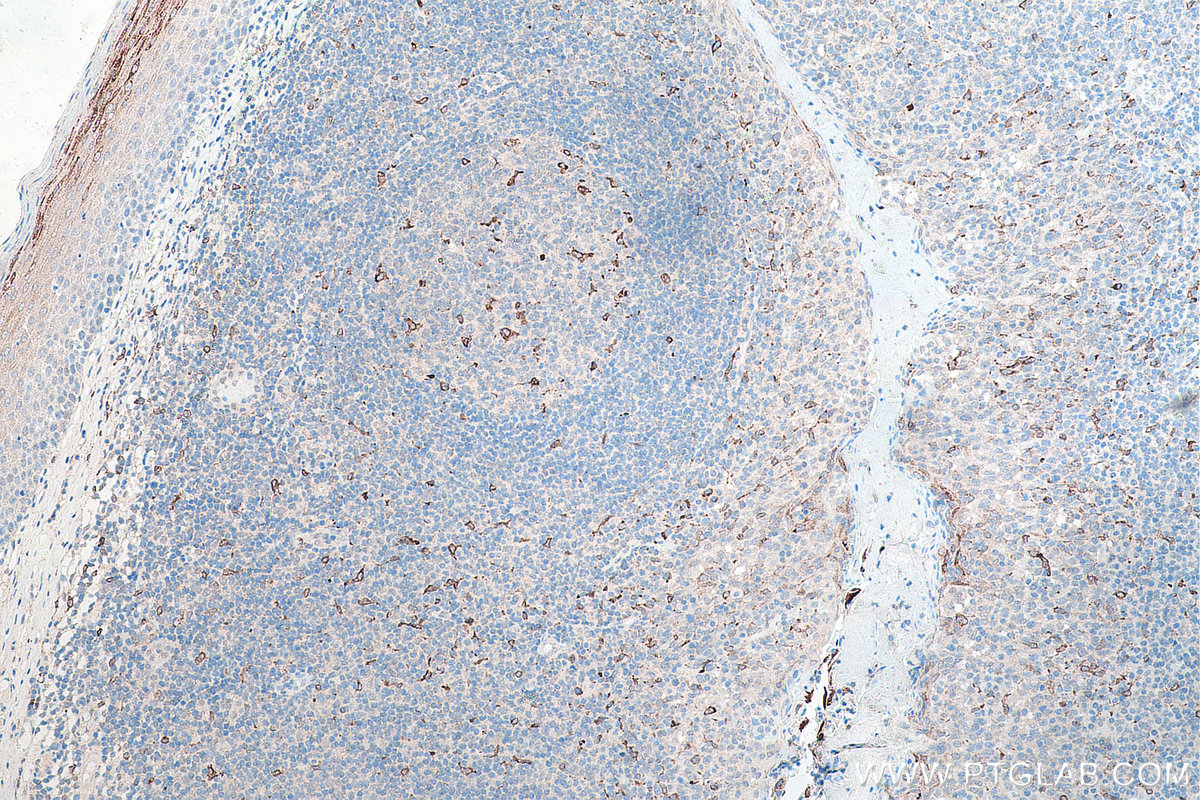 Immunohistochemical analysis of paraffin-embedded human tonsillitis tissue slide using KHC0006 (CD68 IHC Kit).