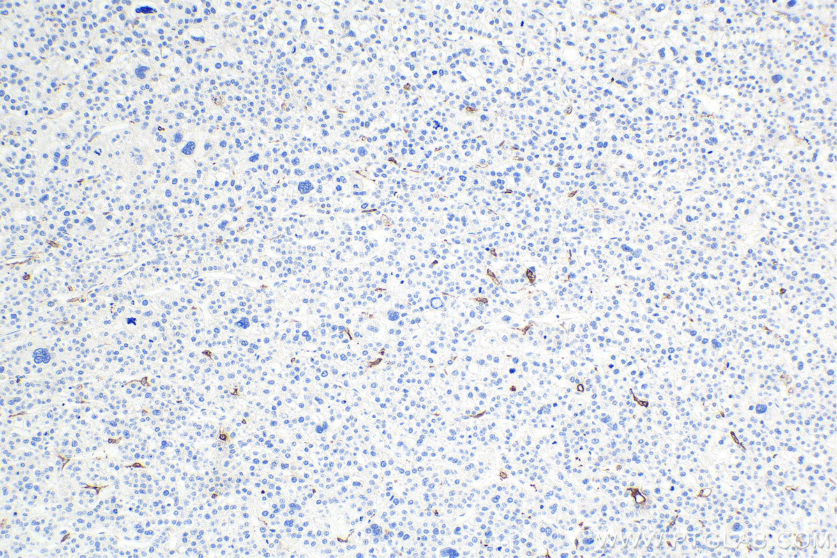 Immunohistochemical analysis of paraffin-embedded human liver cancer tissue slide using KHC0006 (CD68 IHC Kit).