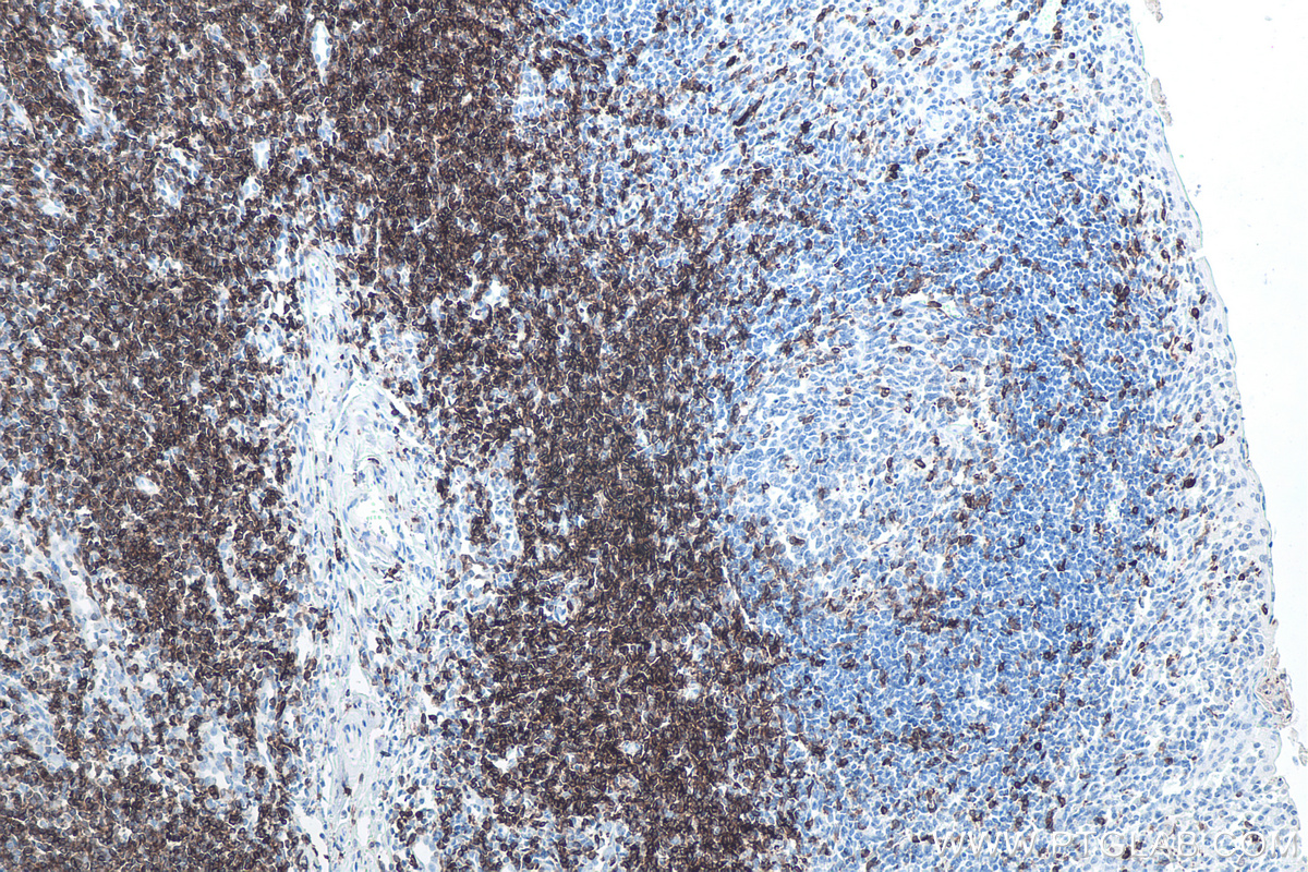 Immunohistochemical analysis of paraffin-embedded human tonsillitis tissue slide using KHC0016 (CD7 IHC Kit).