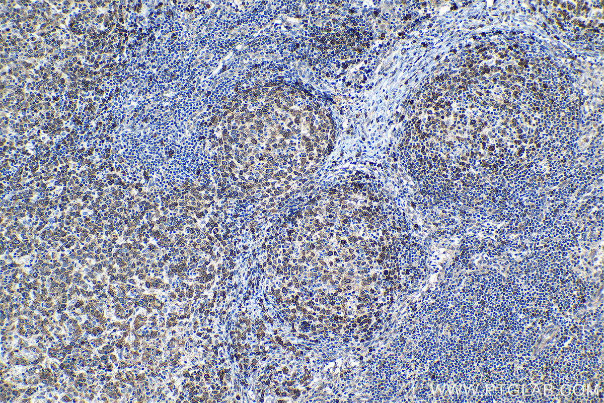 Immunohistochemical analysis of paraffin-embedded human lymphoma tissue slide using KHC1554 (CD79a IHC Kit).