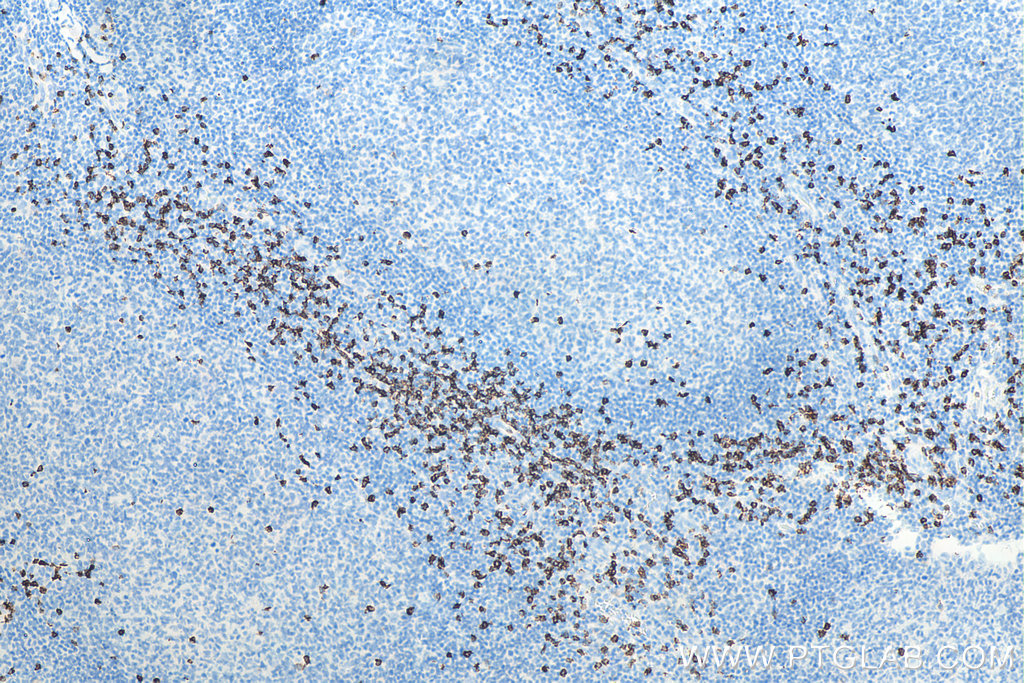 Immunohistochemical analysis of paraffin-embedded human tonsillitis tissue slide using KHC0014 (CD8 IHC Kit).