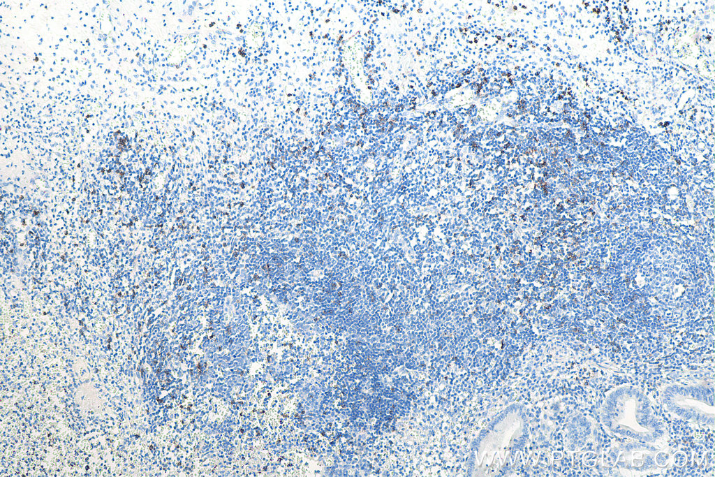 Immunohistochemical analysis of paraffin-embedded human appendicitis tissue slide using KHC0014 (CD8 IHC Kit).