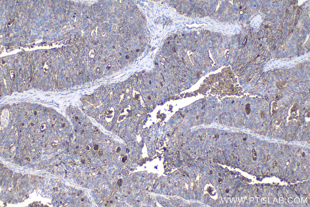 Immunohistochemical analysis of paraffin-embedded human ovary tumor tissue slide using KHC1120 (CD9 IHC Kit).
