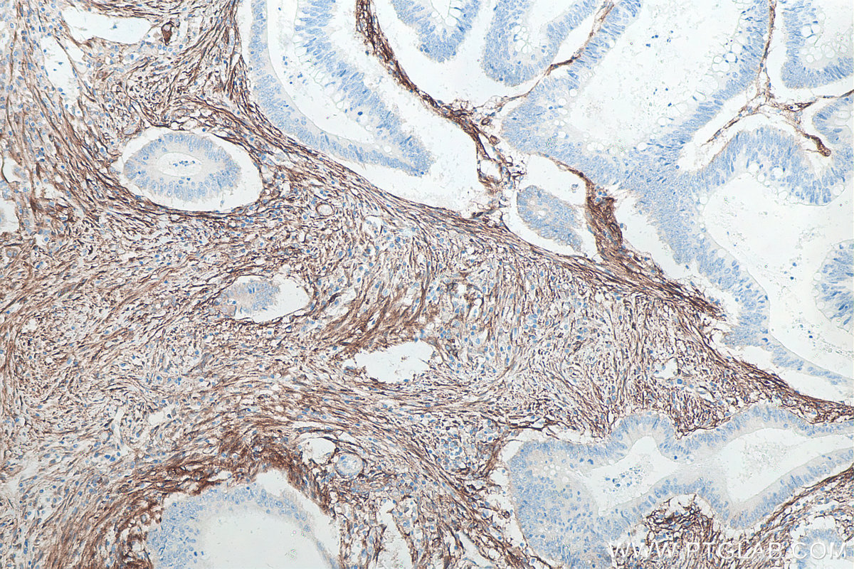 Immunohistochemical analysis of paraffin-embedded human colon cancer tissue slide using KHC0081 (CD90 IHC Kit).