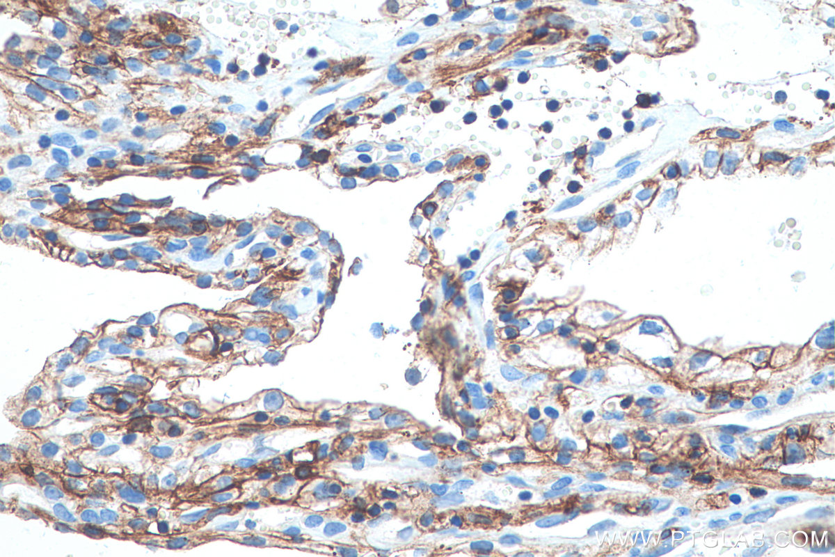 Immunohistochemical analysis of paraffin-embedded human renal cell carcinoma tissue slide using KHC0953 (CD98/SLC3A2 IHC Kit).