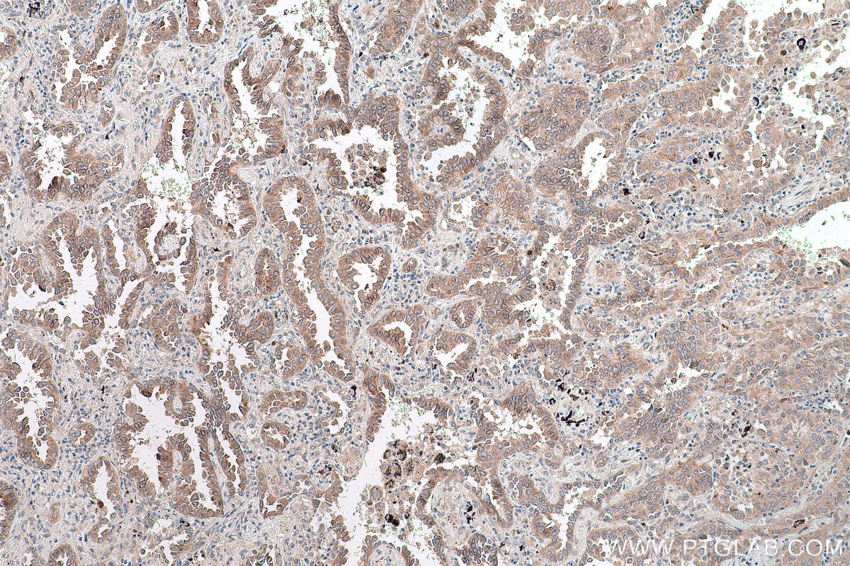 Immunohistochemical analysis of paraffin-embedded human lung cancer tissue slide using KHC0609 (Cdc20 IHC Kit).
