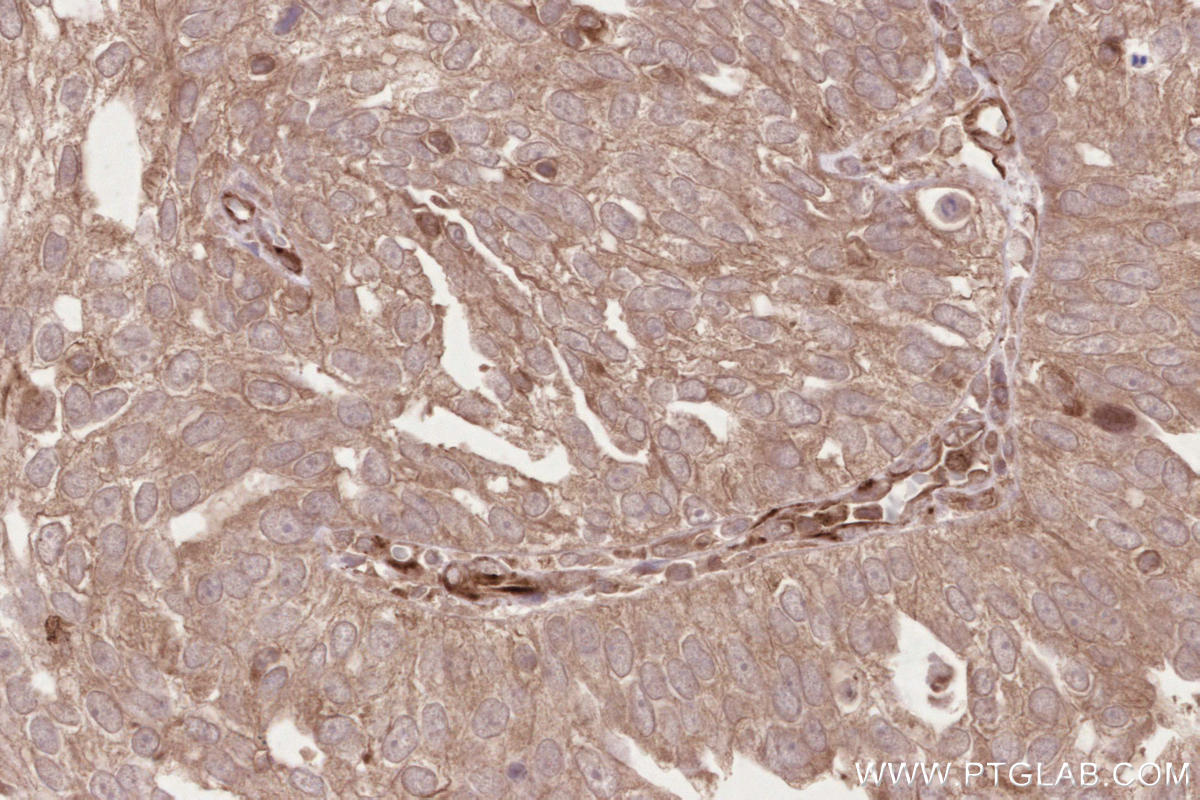Immunohistochemical analysis of paraffin-embedded human ovary cancer tissue slide using KHC2639 (CDC20B IHC Kit).