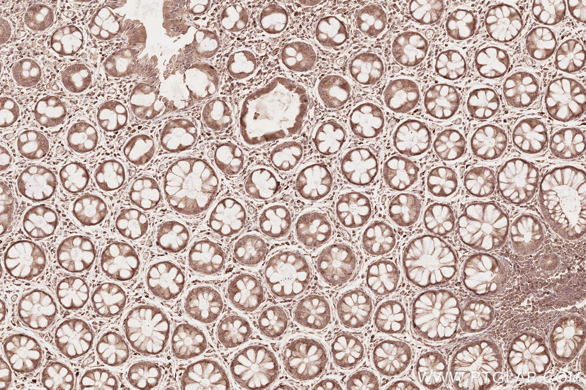 Immunohistochemical analysis of paraffin-embedded human rectal cancer tissue slide using KHC2639 (CDC20B IHC Kit).