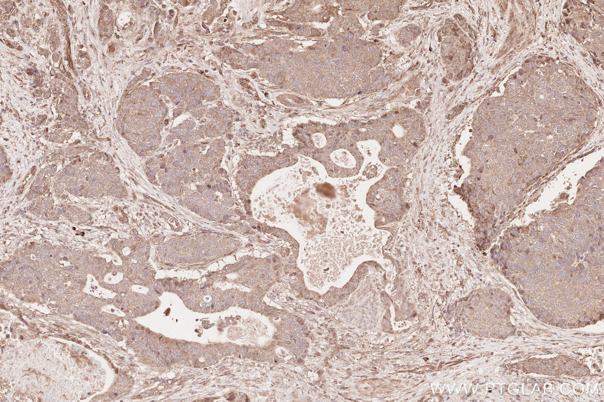 Immunohistochemical analysis of paraffin-embedded human stomach cancer tissue slide using KHC2639 (CDC20B IHC Kit).