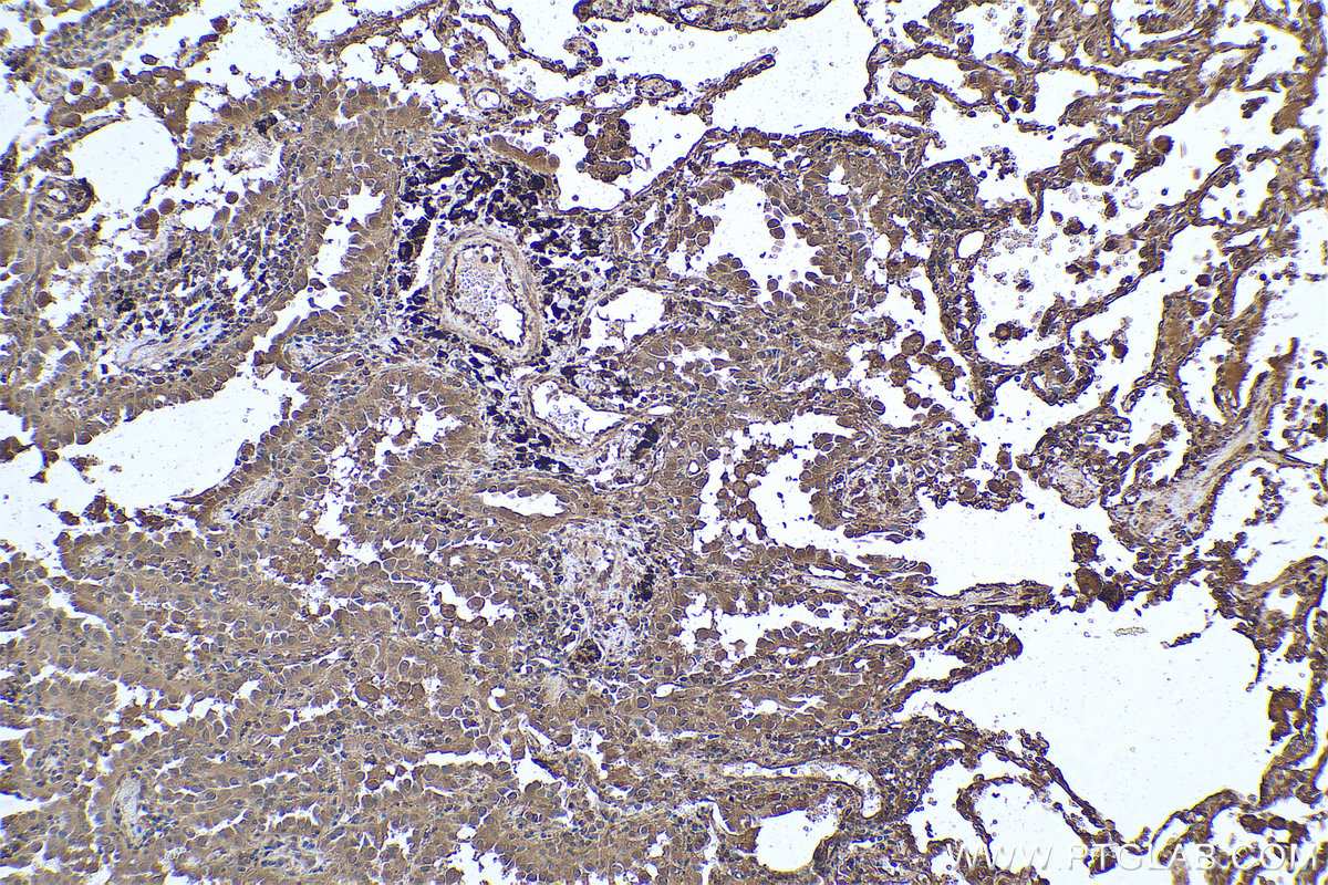 Immunohistochemical analysis of paraffin-embedded human lung cancer tissue slide using KHC0805 (CDC25B IHC Kit).
