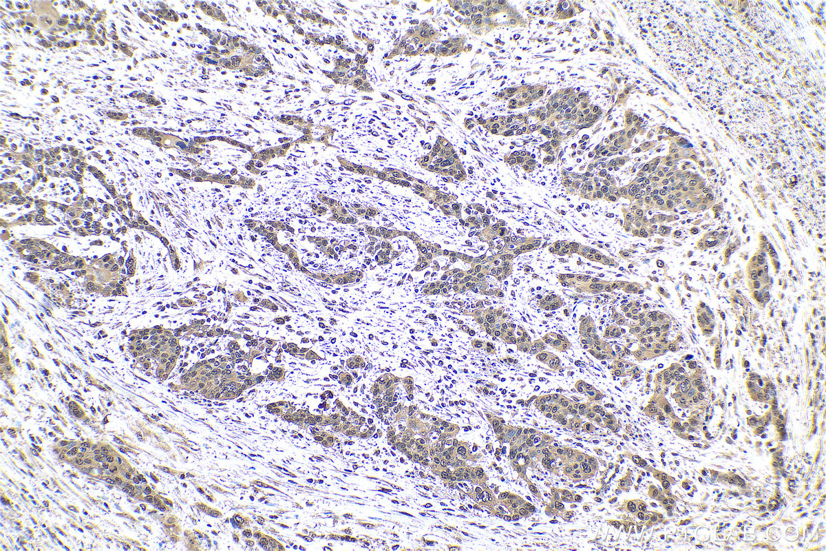 Immunohistochemical analysis of paraffin-embedded human oesophagus cancer tissue slide using KHC0805 (CDC25B IHC Kit).