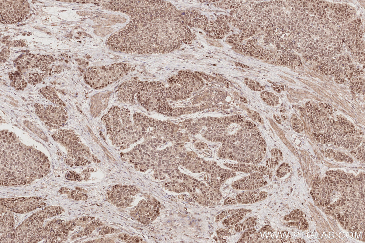 Immunohistochemical analysis of paraffin-embedded human stomach cancer tissue slide using KHC2879 (CDC2L6 IHC Kit).