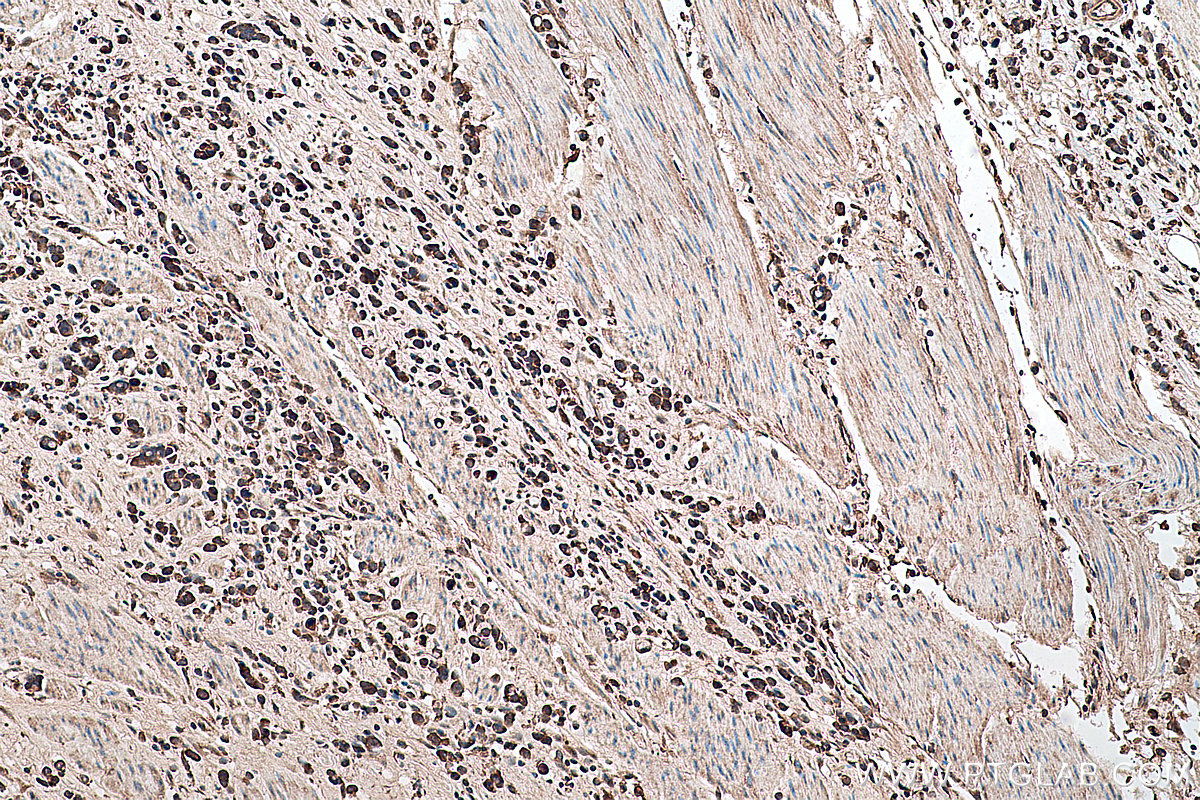 Immunohistochemical analysis of paraffin-embedded human stomach cancer tissue slide using KHC0408 (CDC37L1 IHC Kit).