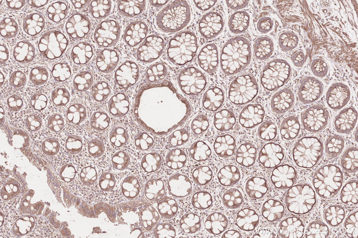Immunohistochemical analysis of paraffin-embedded human rectal cancer tissue slide using KHC2562 (CDC42BPA IHC Kit).