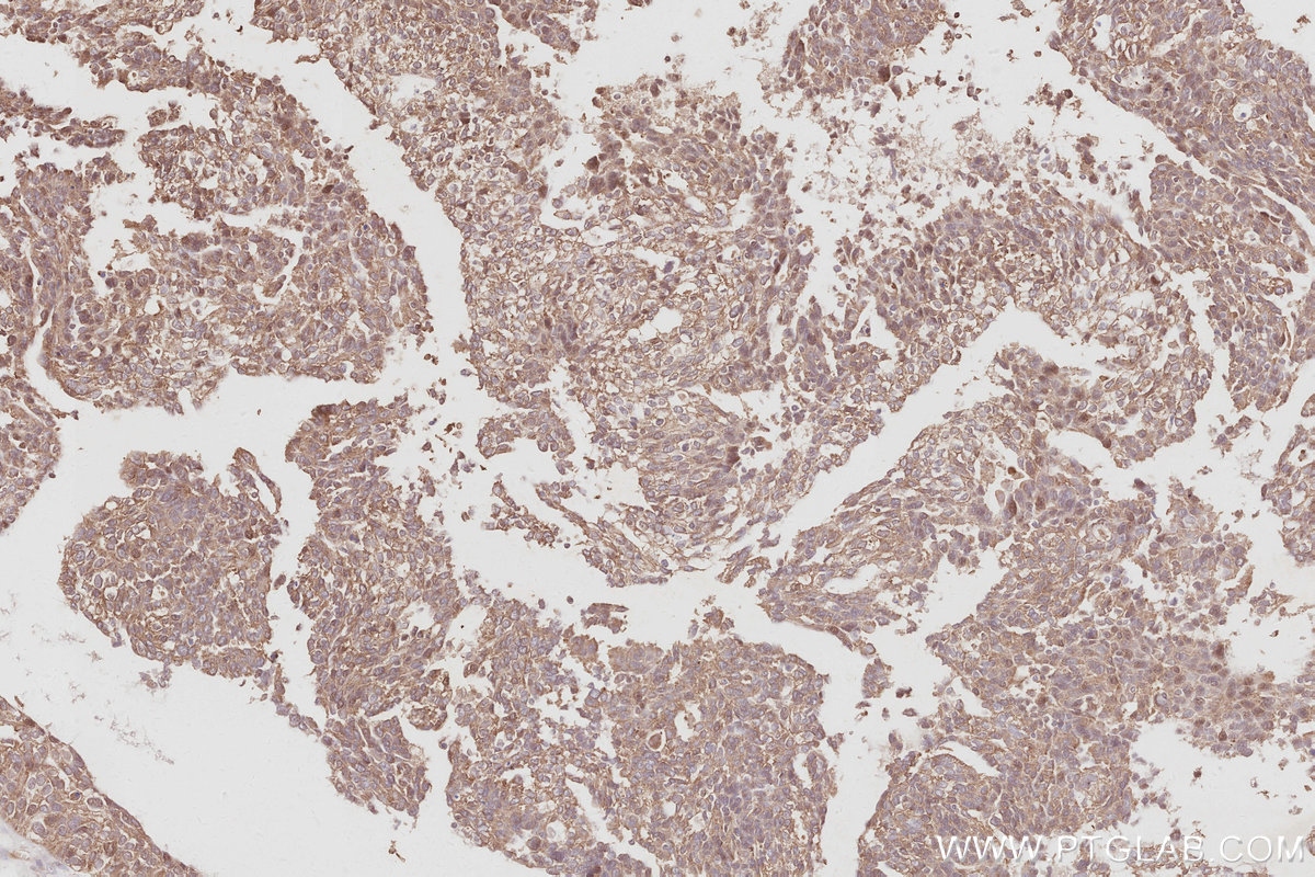 Immunohistochemical analysis of paraffin-embedded human ovary cancer tissue slide using KHC3080 (CDC42BPB IHC Kit).