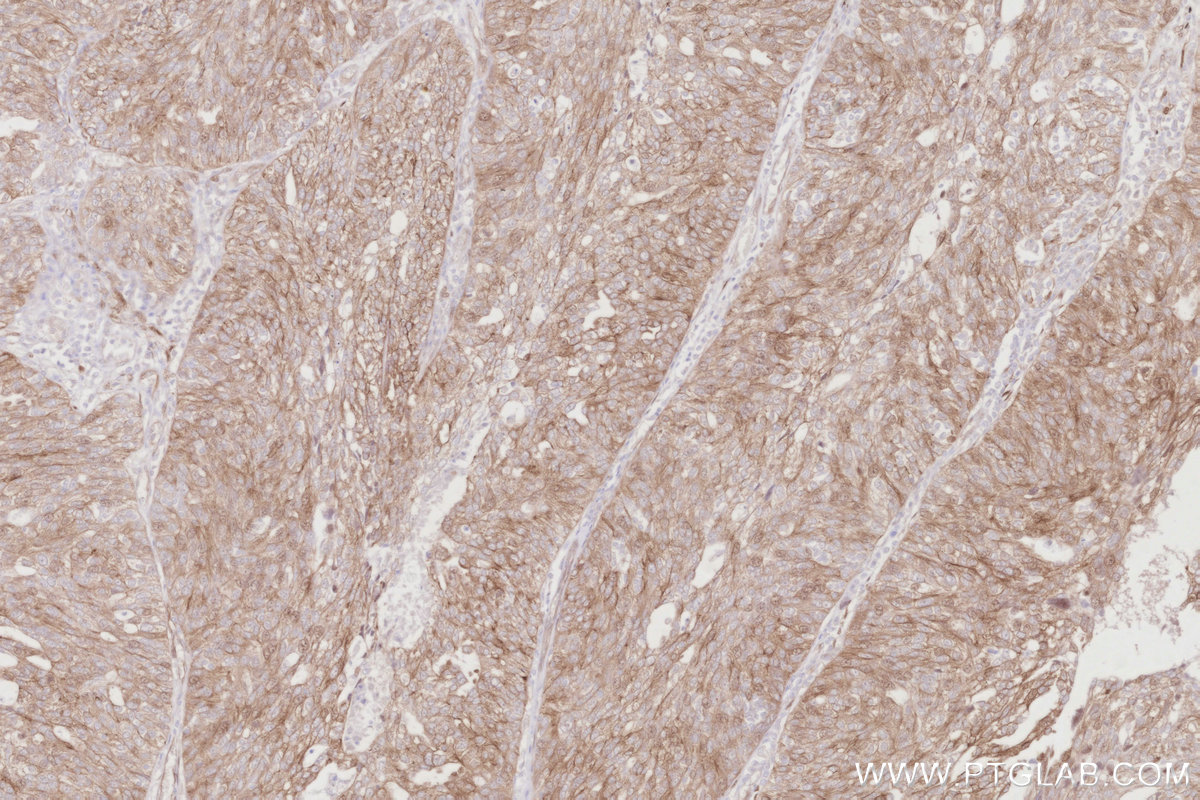Immunohistochemical analysis of paraffin-embedded human ovary cancer tissue slide using KHC2911 (CDC42EP4 IHC Kit).