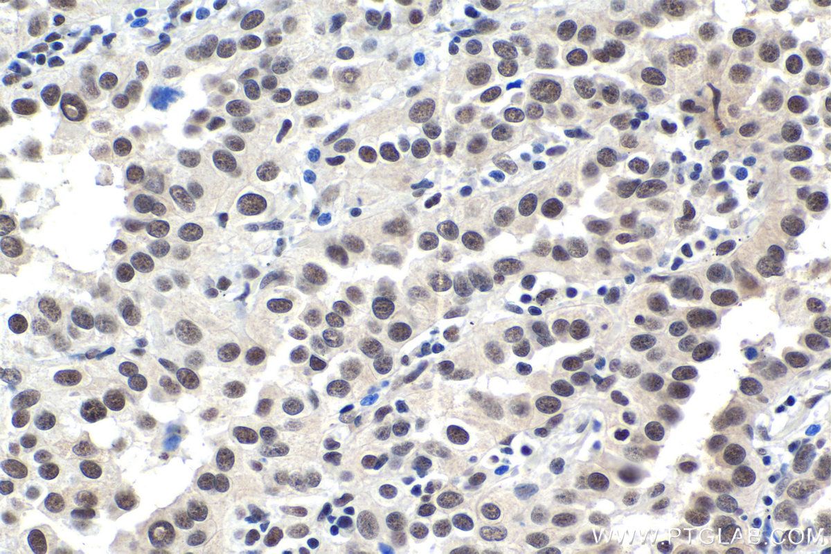 Immunohistochemical analysis of paraffin-embedded human lung cancer tissue slide using KHC1814 (CDC73 IHC Kit).