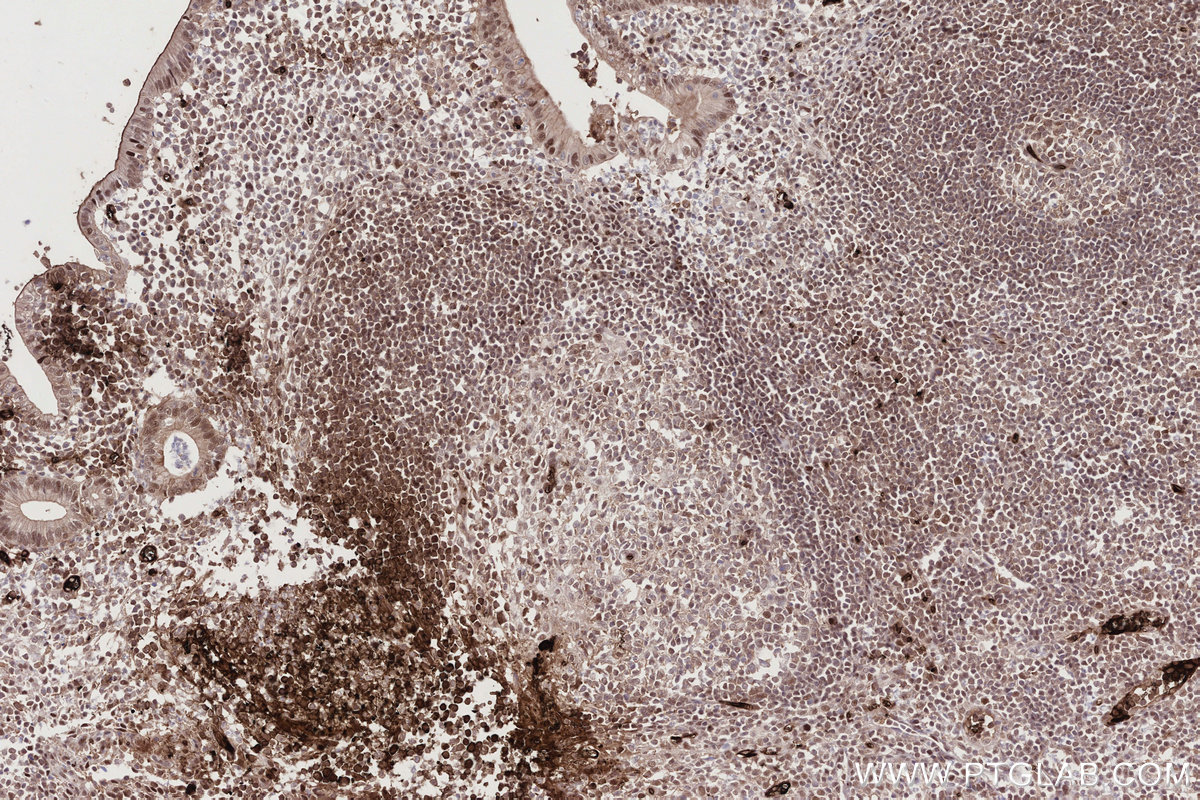 Immunohistochemical analysis of paraffin-embedded human appendicitis tissue slide using KHC2791 (CDCA5 IHC Kit).