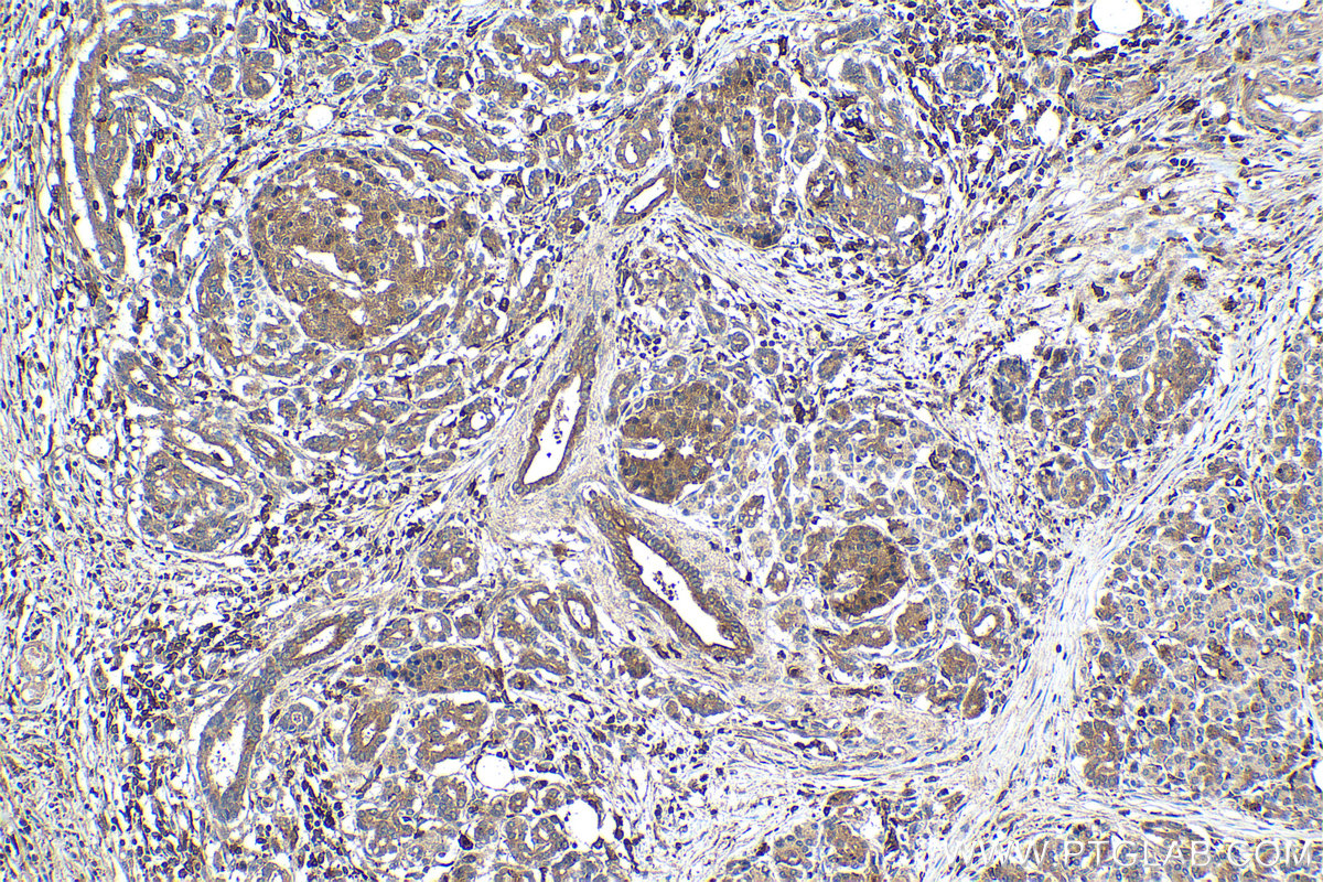 Immunohistochemical analysis of paraffin-embedded human pancreas cancer tissue slide using KHC1511 (CDK1 IHC Kit).