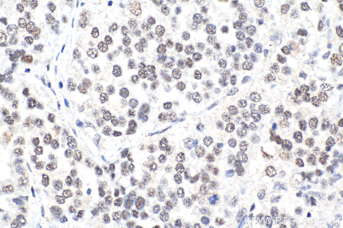 Immunohistochemical analysis of paraffin-embedded human ovary tumor tissue slide using KHC2124 (CDK2AP2 IHC Kit).