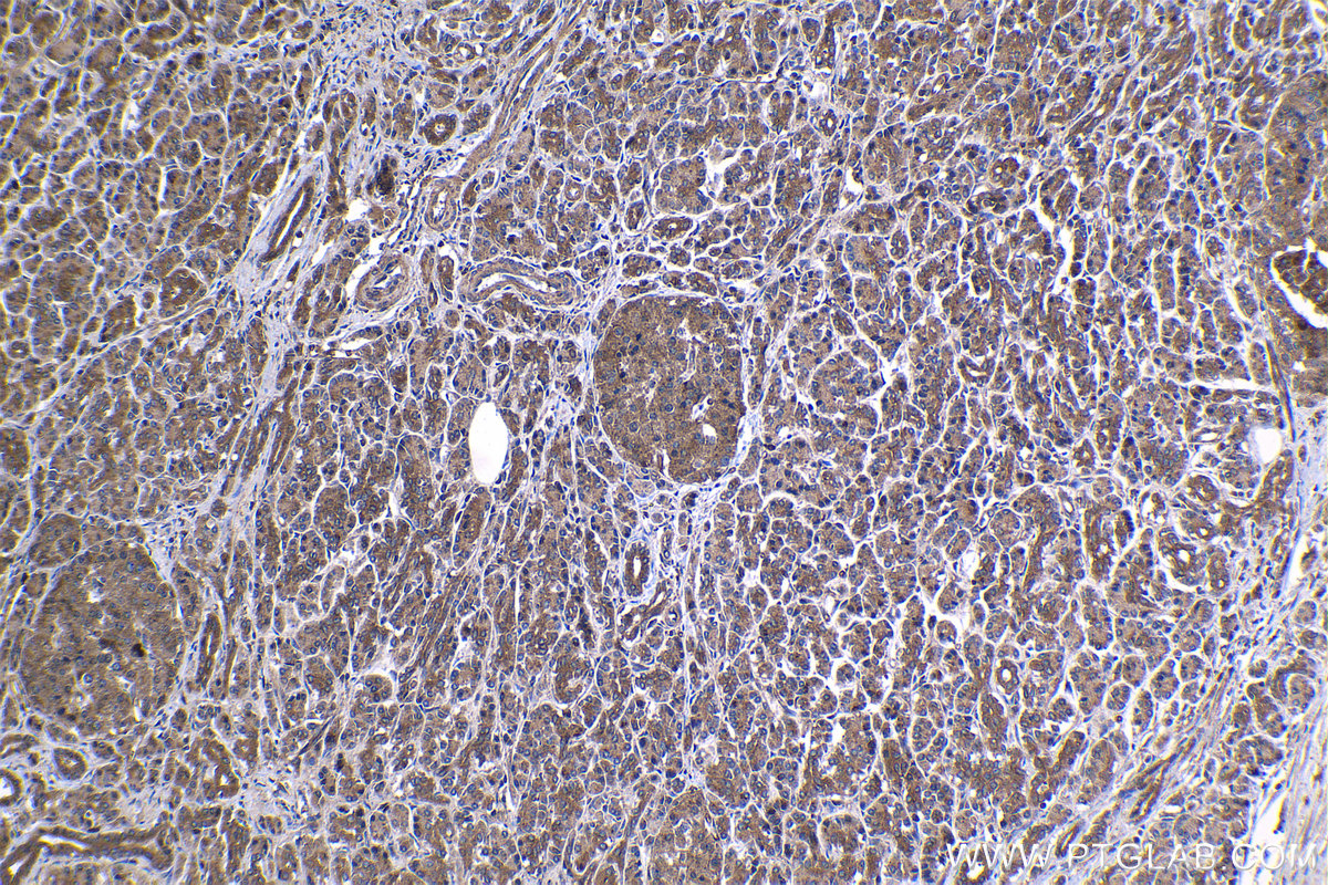 Immunohistochemical analysis of paraffin-embedded human pancreas cancer tissue slide using KHC1187 (CDK3 IHC Kit).