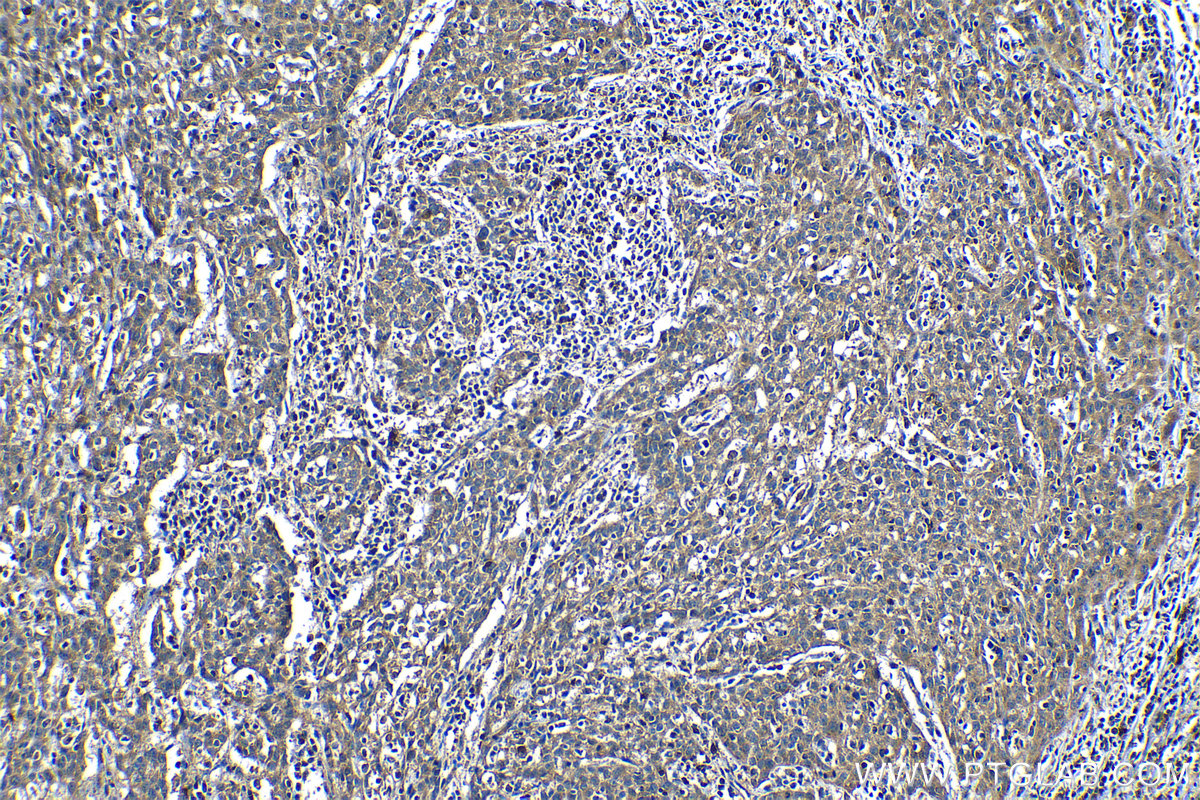 Immunohistochemical analysis of paraffin-embedded human cervical cancer tissue slide using KHC1187 (CDK3 IHC Kit).