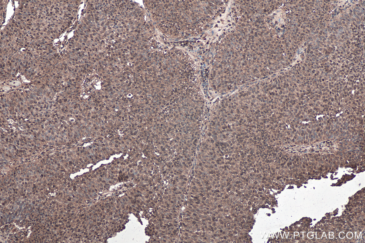 Immunohistochemical analysis of paraffin-embedded human urothelial carcinoma tissue slide using KHC0303 (CDK4 IHC Kit).