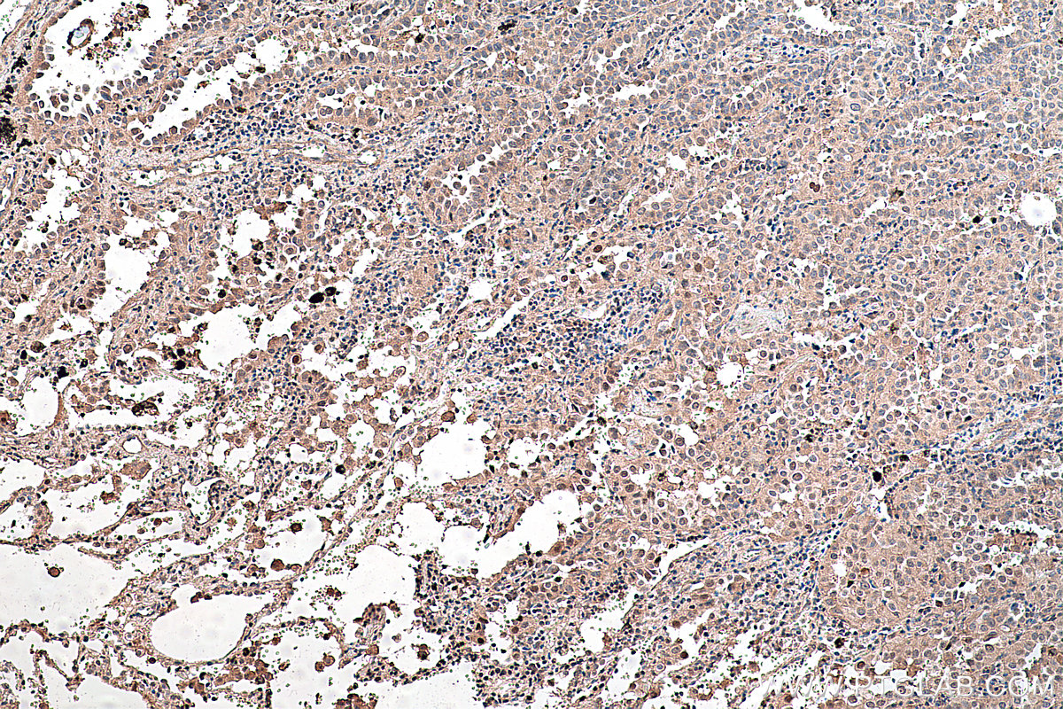 Immunohistochemical analysis of paraffin-embedded human lung cancer tissue slide using KHC0303 (CDK4 IHC Kit).