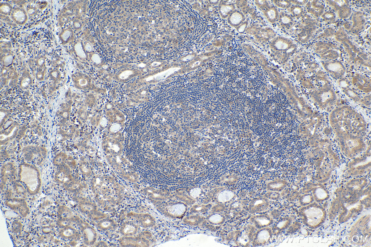 Immunohistochemical analysis of paraffin-embedded human thyroid cancer tissue slide using KHC1657 (CDK5 IHC Kit).