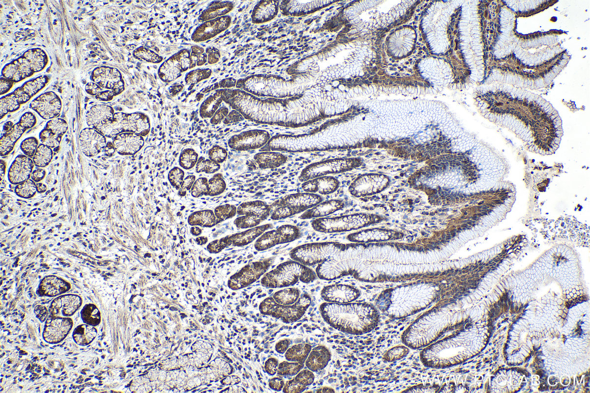 Immunohistochemical analysis of paraffin-embedded human stomach cancer tissue slide using KHC1068 (CDK6 IHC Kit).