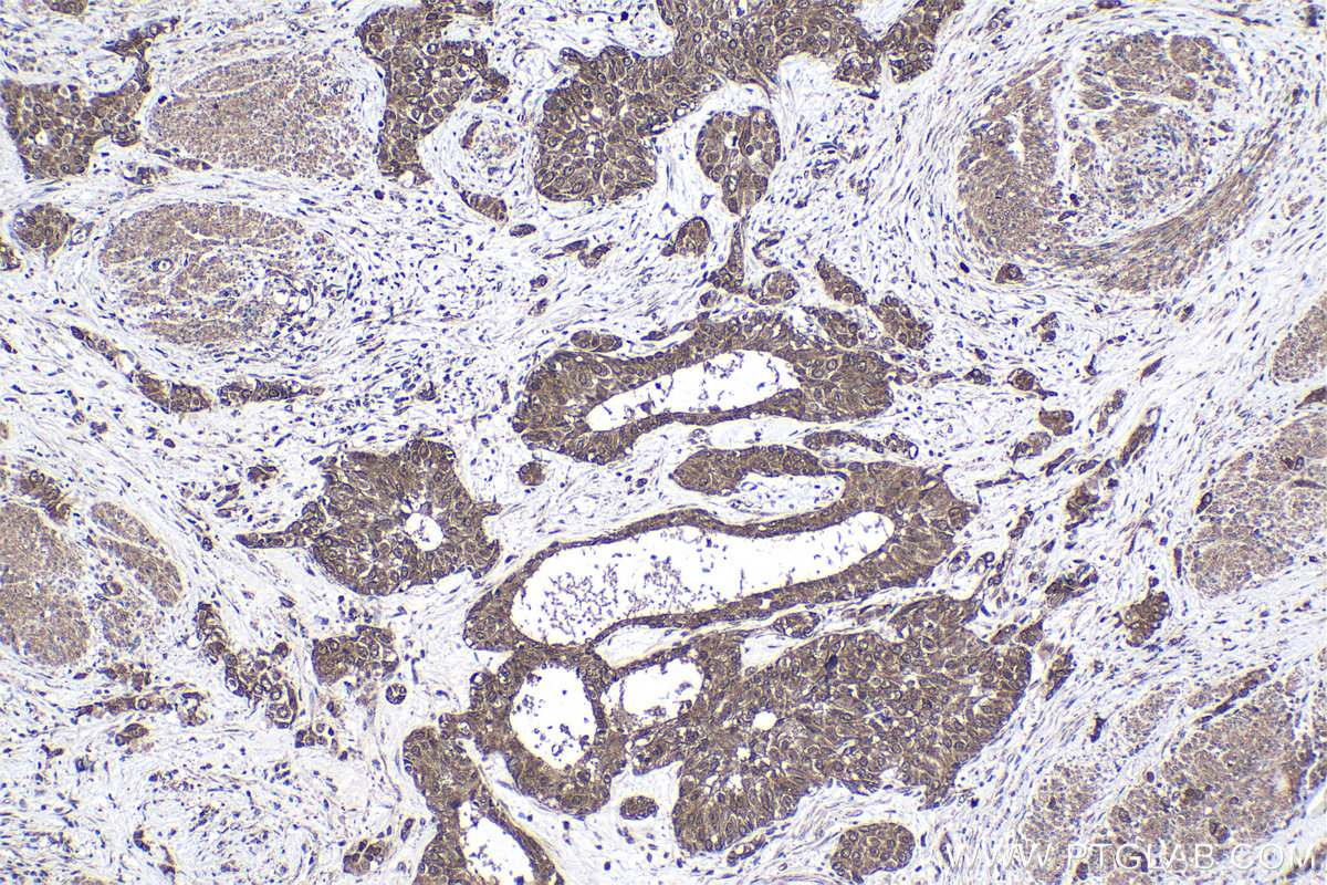 Immunohistochemical analysis of paraffin-embedded human urothelial carcinoma tissue slide using KHC1616 (CDK7 IHC Kit).