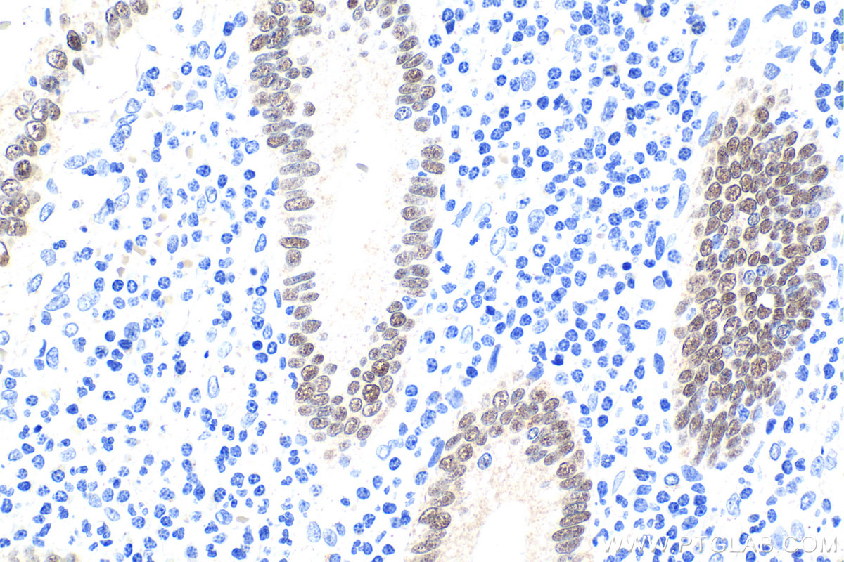 Immunohistochemical analysis of paraffin-embedded human appendicitis tissue slide using KHC1894 (CDX2 IHC Kit).