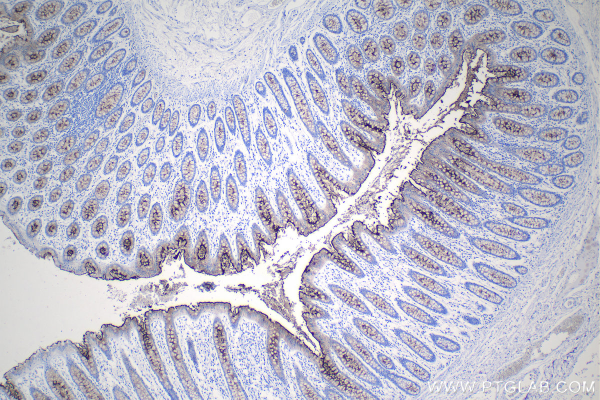 Immunohistochemical analysis of paraffin-embedded human colon tissue slide using KHC1112 (CEA IHC Kit).